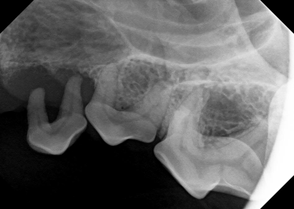 In the image, you can see a tooth literally “floating” in the gum tissue with no bone surrounding it at all. This tooth has to be extracted.
