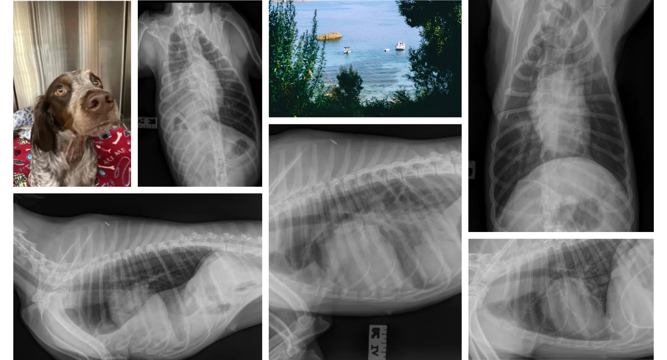 Diaphragmatic Hernia Surgery Diaphragmatic Hernia Surgery