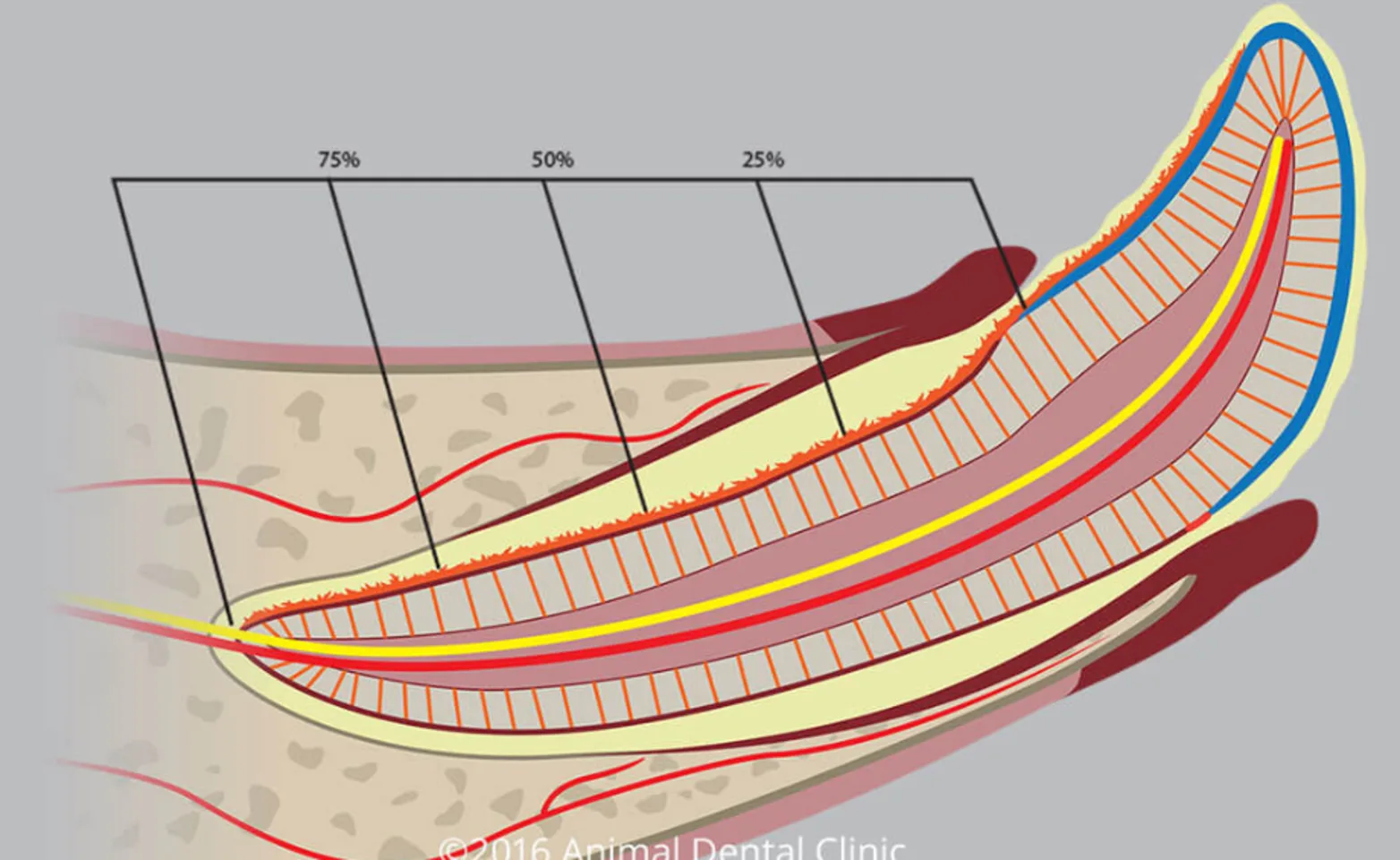Diagram of a tooth with gingivitis Diagram of a tooth with gingivitis