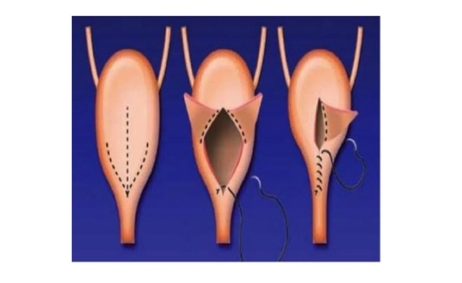 Urethral Lengthening. From McLoughlin and Chew’s “Surgical Views: Surgical Treatment of Urethral Sphincter Mechanism Incompetence in Female Dogs.” Compendium 2009. Urethral Lengthening. From McLoughlin and Chew’s “Surgical Views: Surgical Treatment of Urethral Sphincter Mechanism Incompetence in Female Dogs.” Compendium 2009.