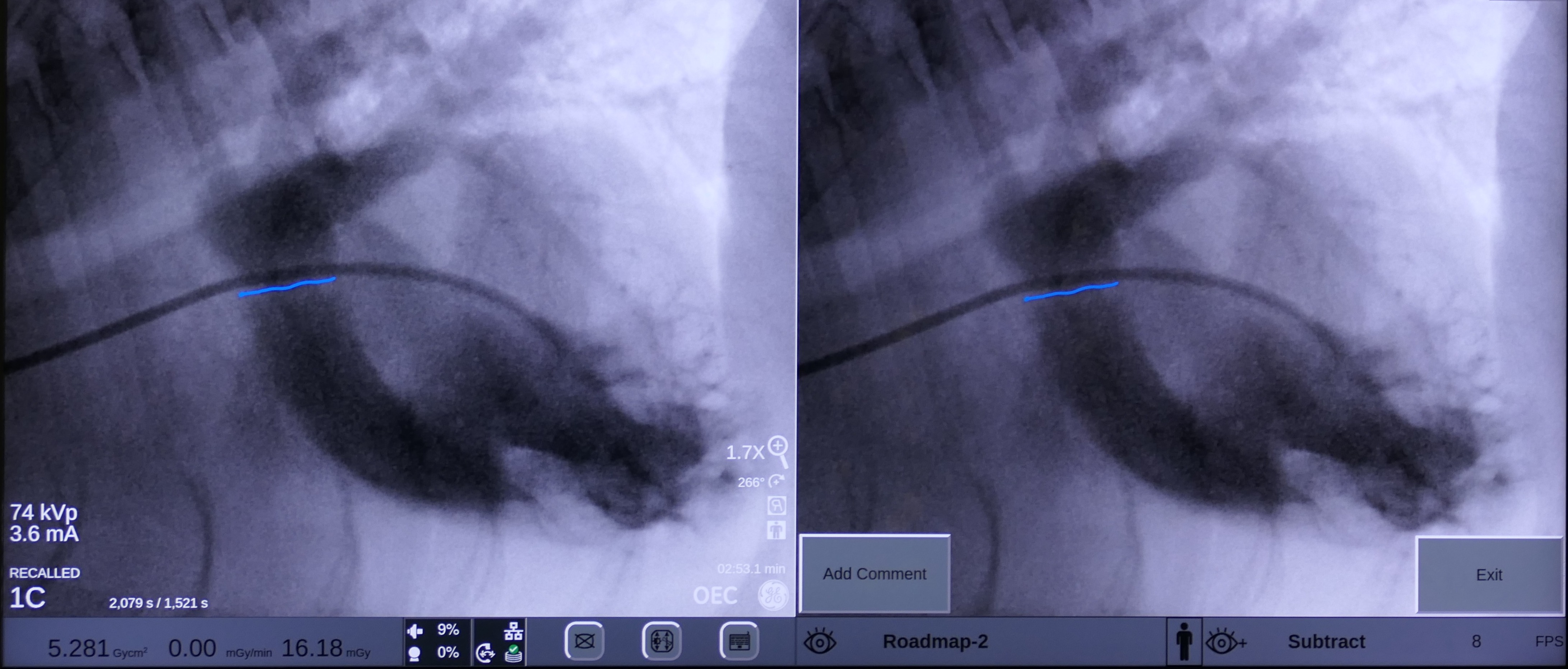 A balloon valvuloplasty X-ray for dogs. 
