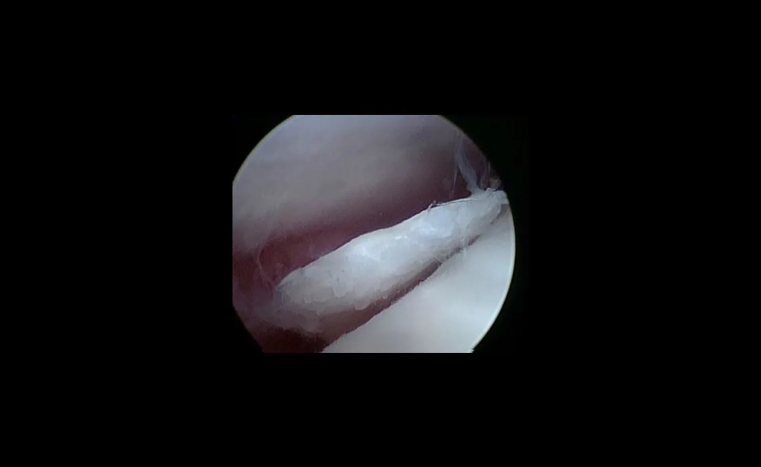 Large cartilage flap in the shoulder of a dog, called caudal humeral osteochondritis dessicans Large cartilage flap in the shoulder of a dog, called caudal humeral osteochondritis dessicans