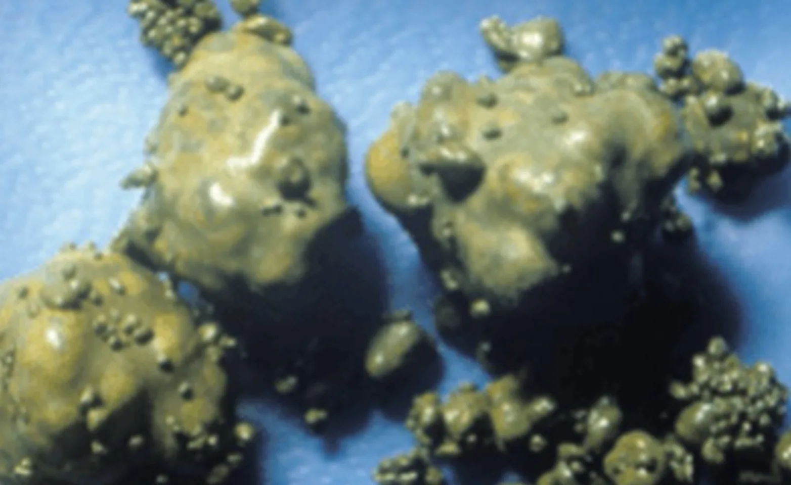 Urate stones Urate stones