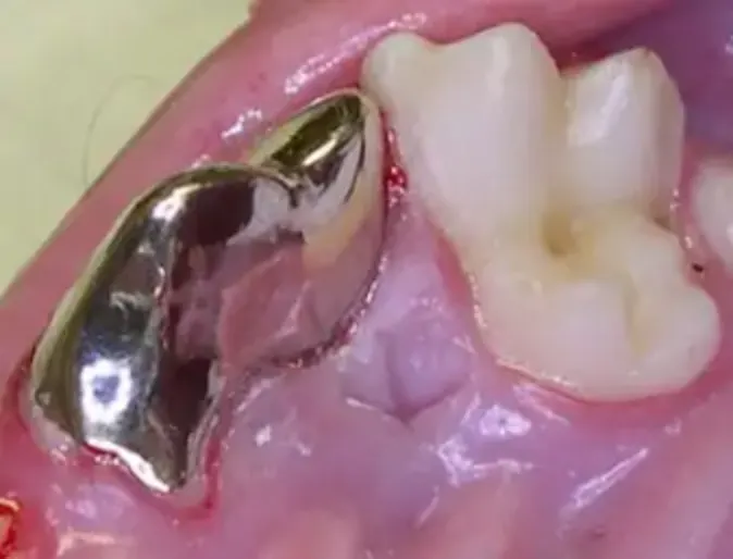 Pet's teeth with metal crowns Pet's teeth with metal crowns