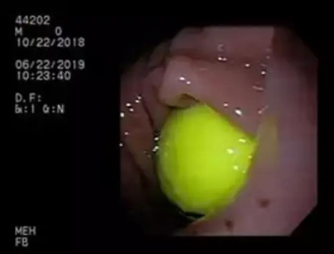 Golf ball lodged in between stomach and lower intestine Golf ball lodged in between stomach and lower intestine