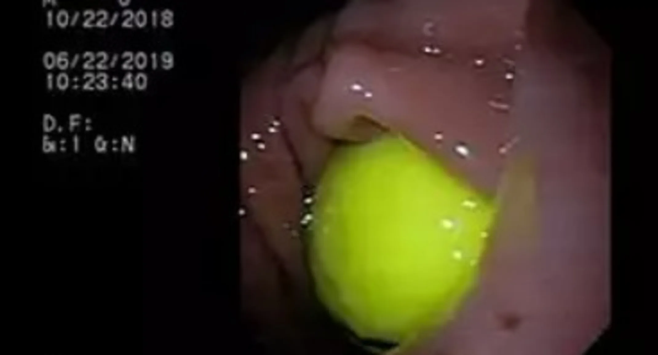 Golf ball lodged in between stomach and lower intestine Golf ball lodged in between stomach and lower intestine