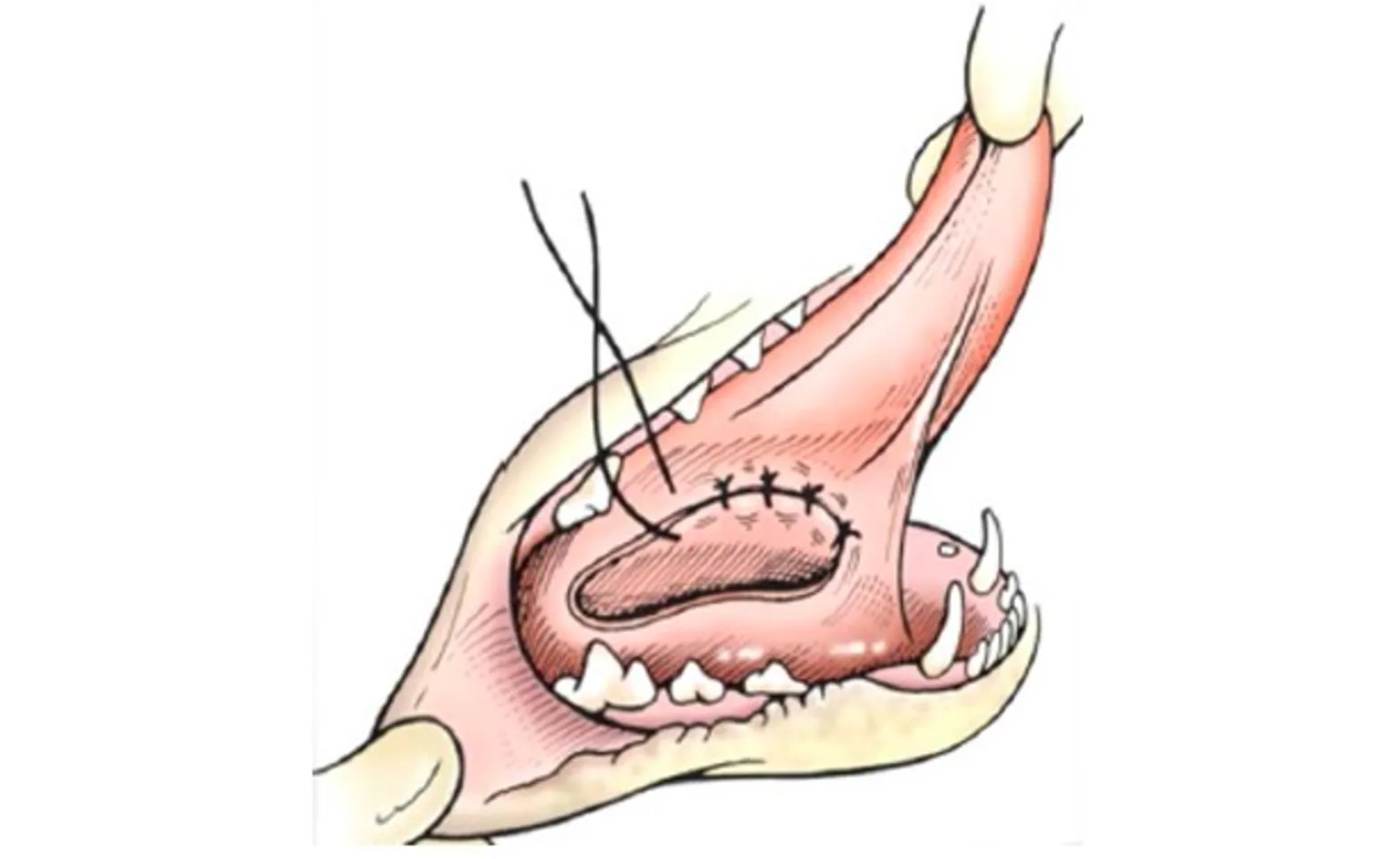 Marsupialization of Sublingual Salivary Mucocele Marsupialization of Sublingual Salivary Mucocele