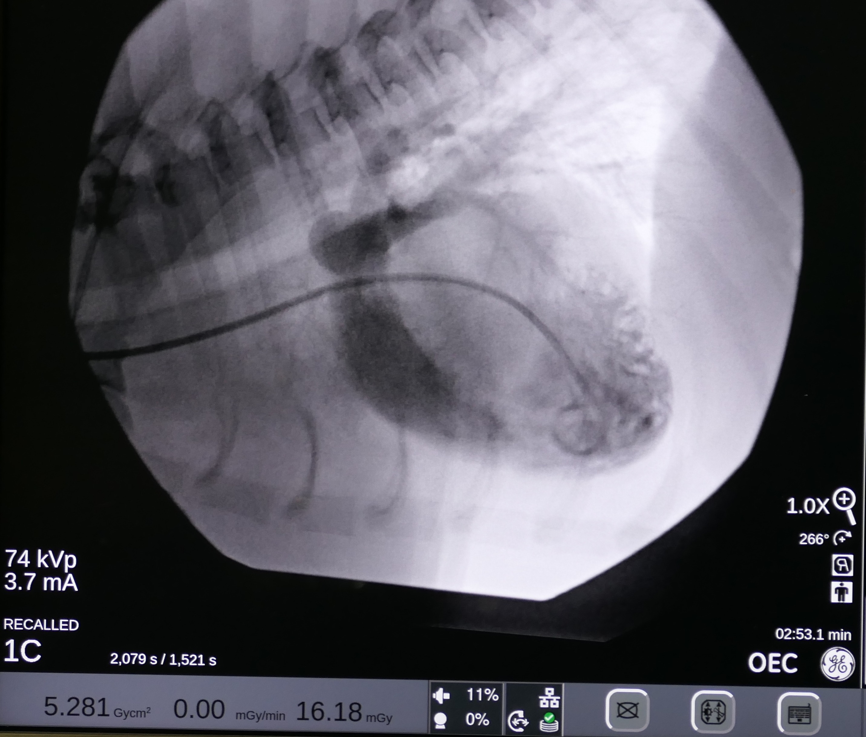 An x-ray image of balloon valvuloplasty. 