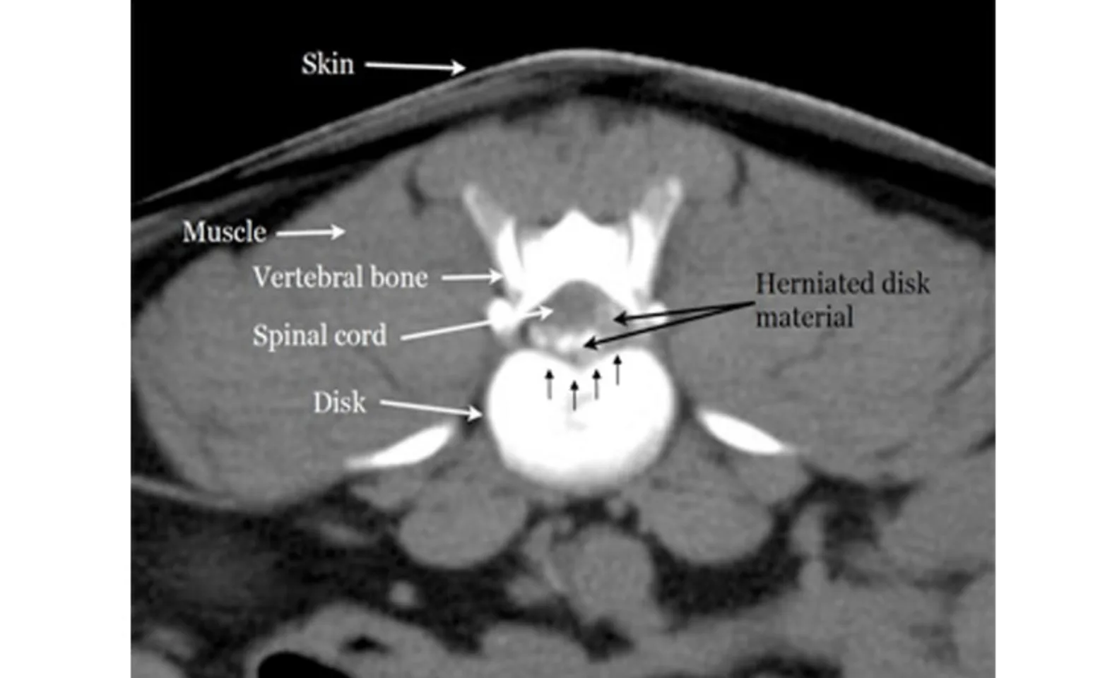 CT image of the spinal cord CT image of the spinal cord