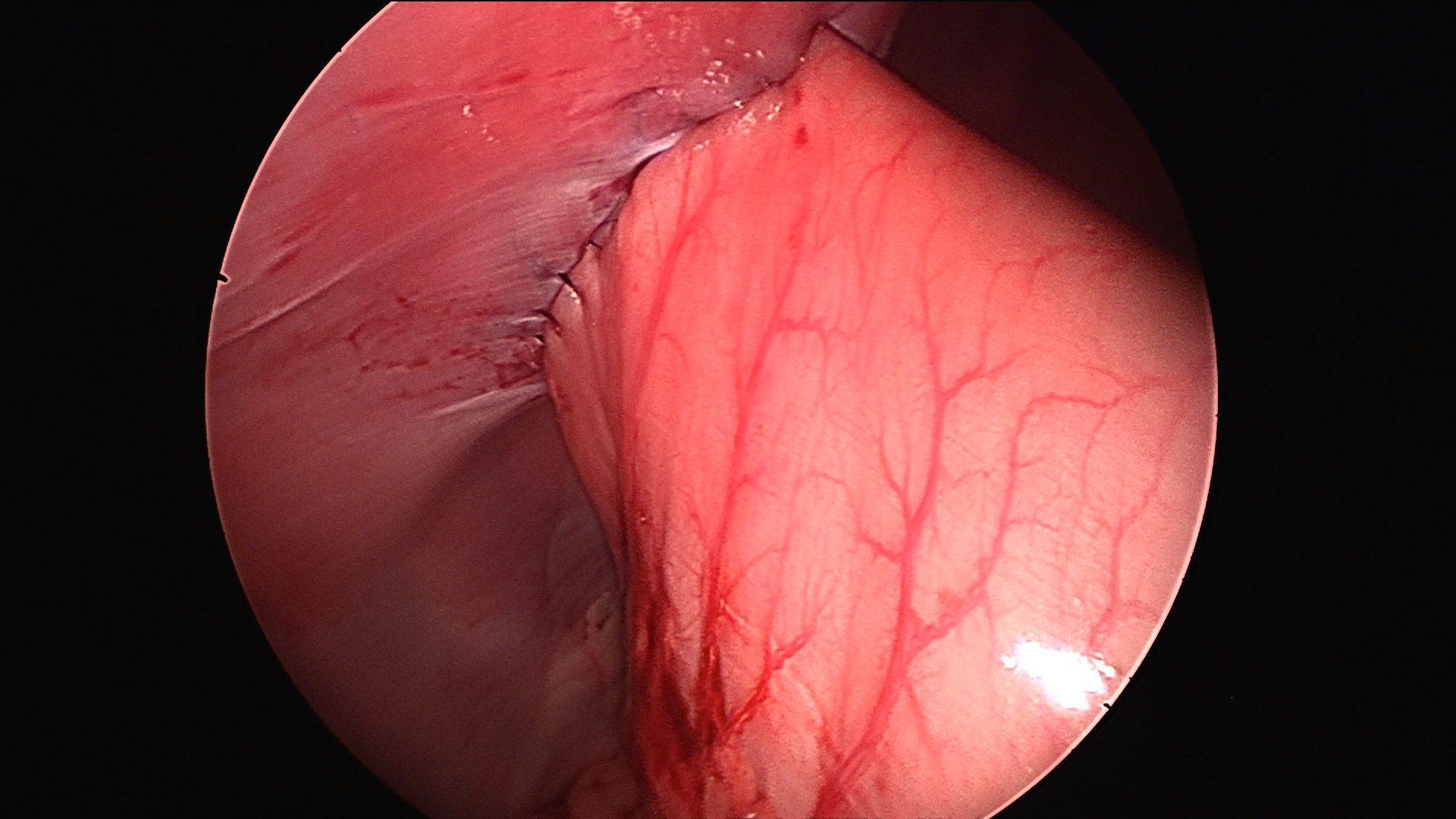 Stomach sutured to the body wall 