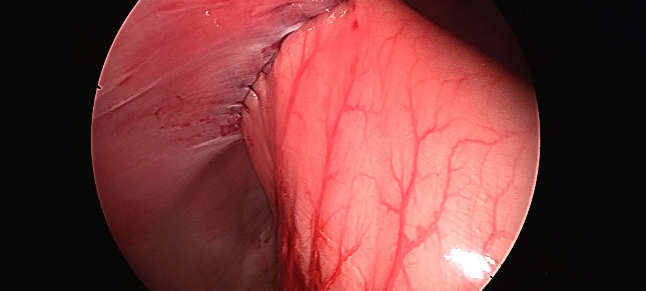 Stomach sutured to the body wall Stomach sutured to the body wall