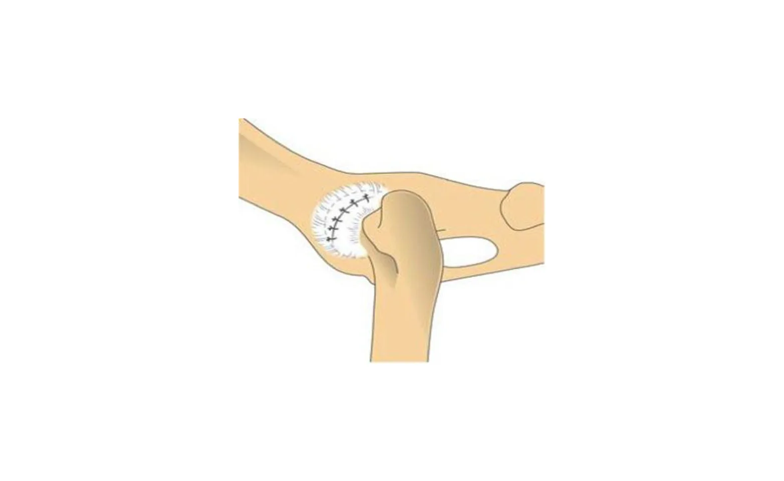 Diagram image of a capsulorraphy Diagram image of a capsulorraphy