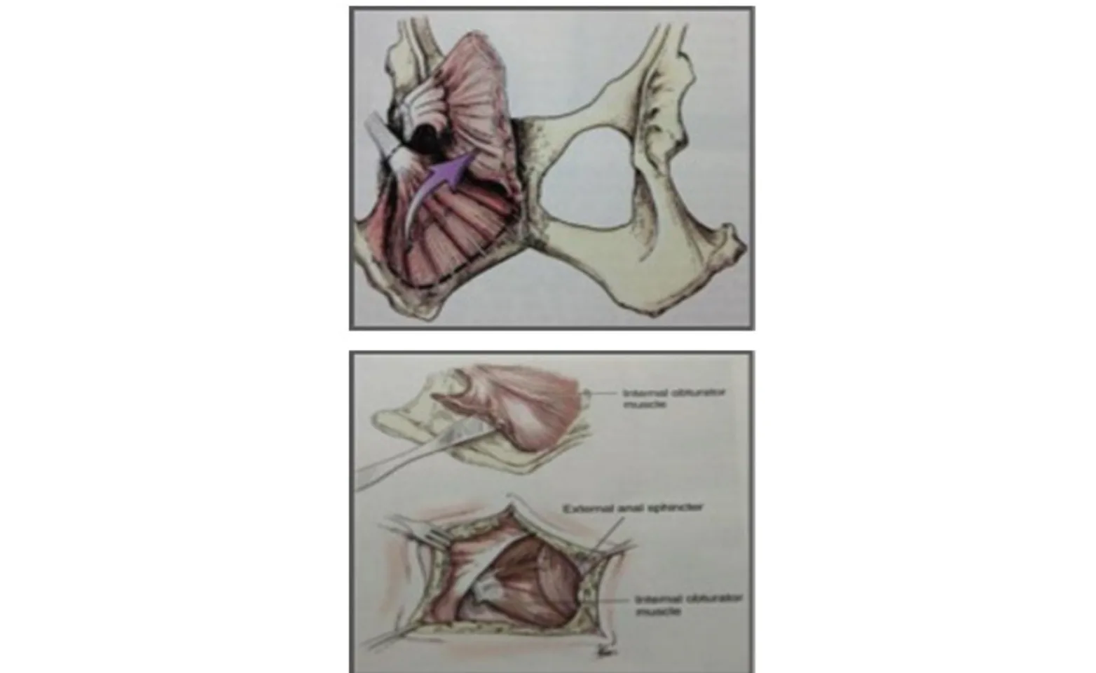 Schematics of the internal obturator muscle transposition procedure Schematics of the internal obturator muscle transposition procedure