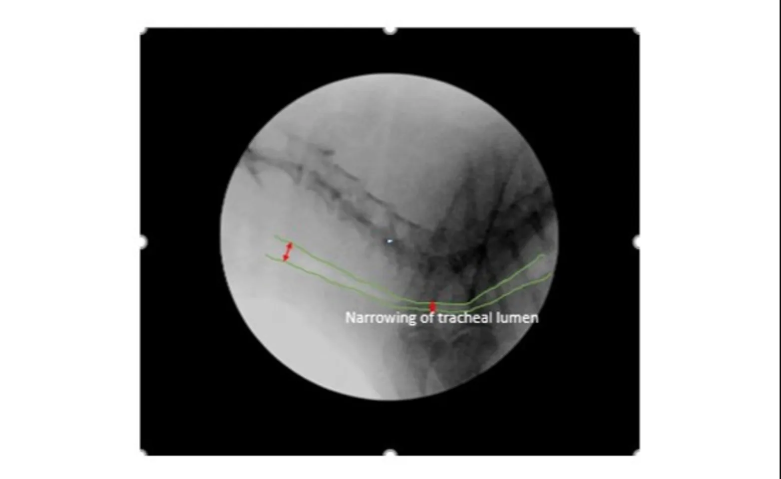 Fluoroscopy image identifying narrowing of the trachea Fluoroscopy image identifying narrowing of the trachea