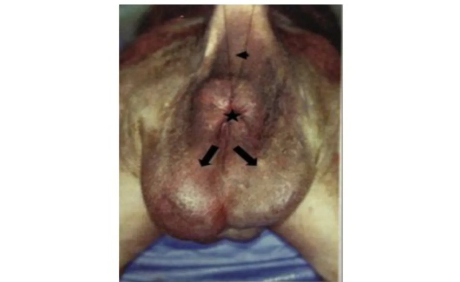 Hind end of a dog with tail raised (arrowhead) with bilateral perineal hernias (arrows) below the anus (star) Hind end of a dog with tail raised (arrowhead) with bilateral perineal hernias (arrows) below the anus (star)