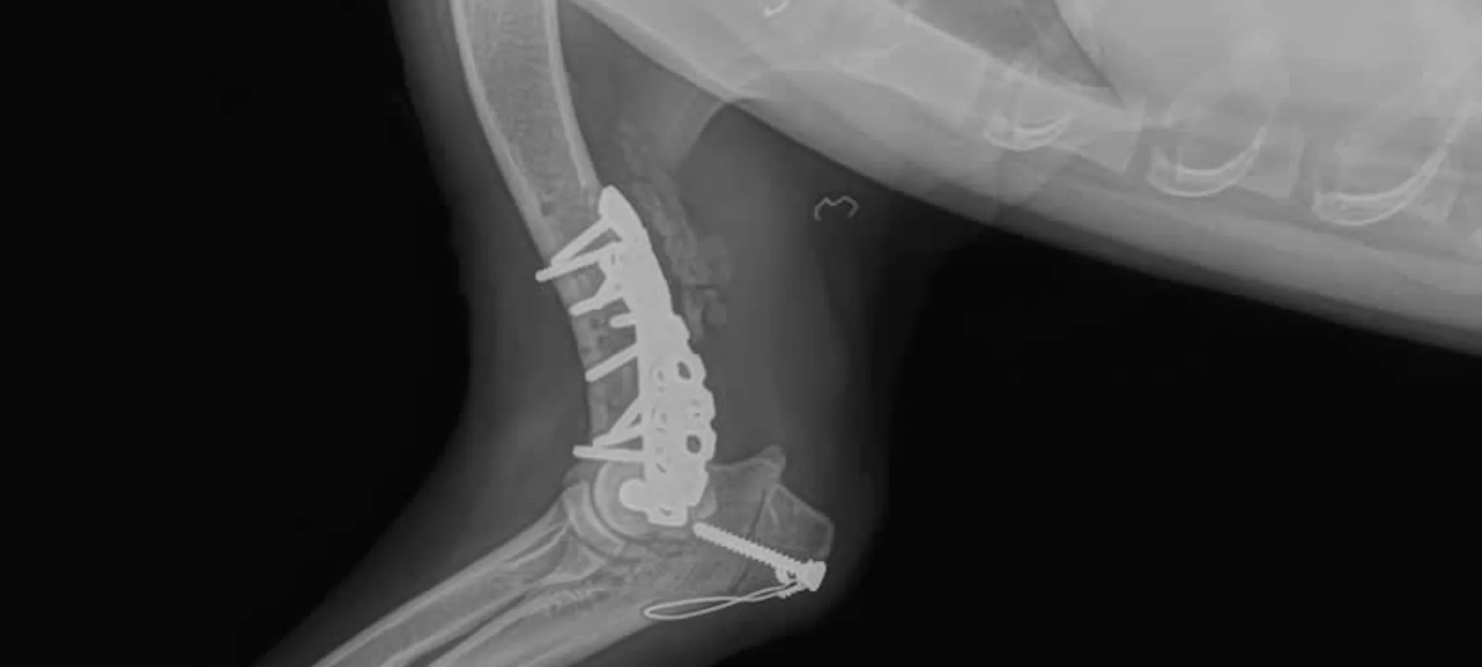 X-ray picture of Locking plate technique X-ray picture of Locking plate technique