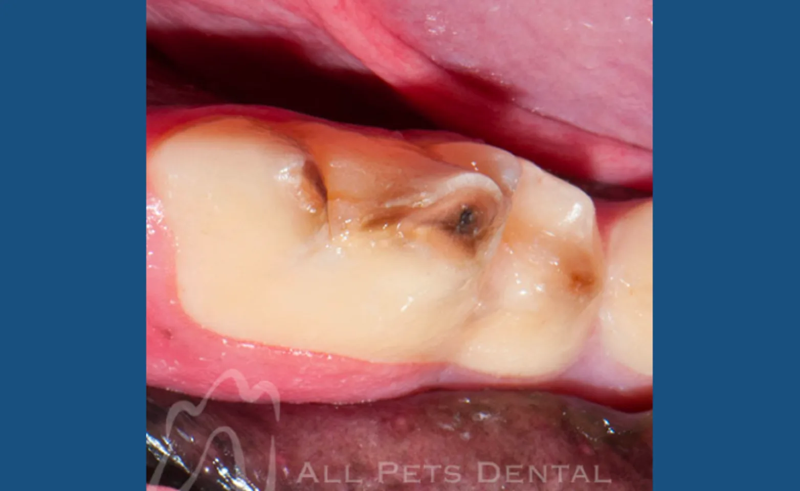 Complicated Crown Fracture