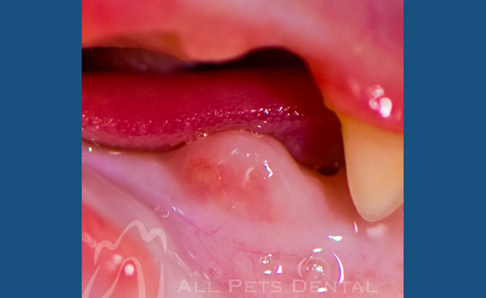 Tooth Resorption Stage 5 Tooth Resorption Stage 5