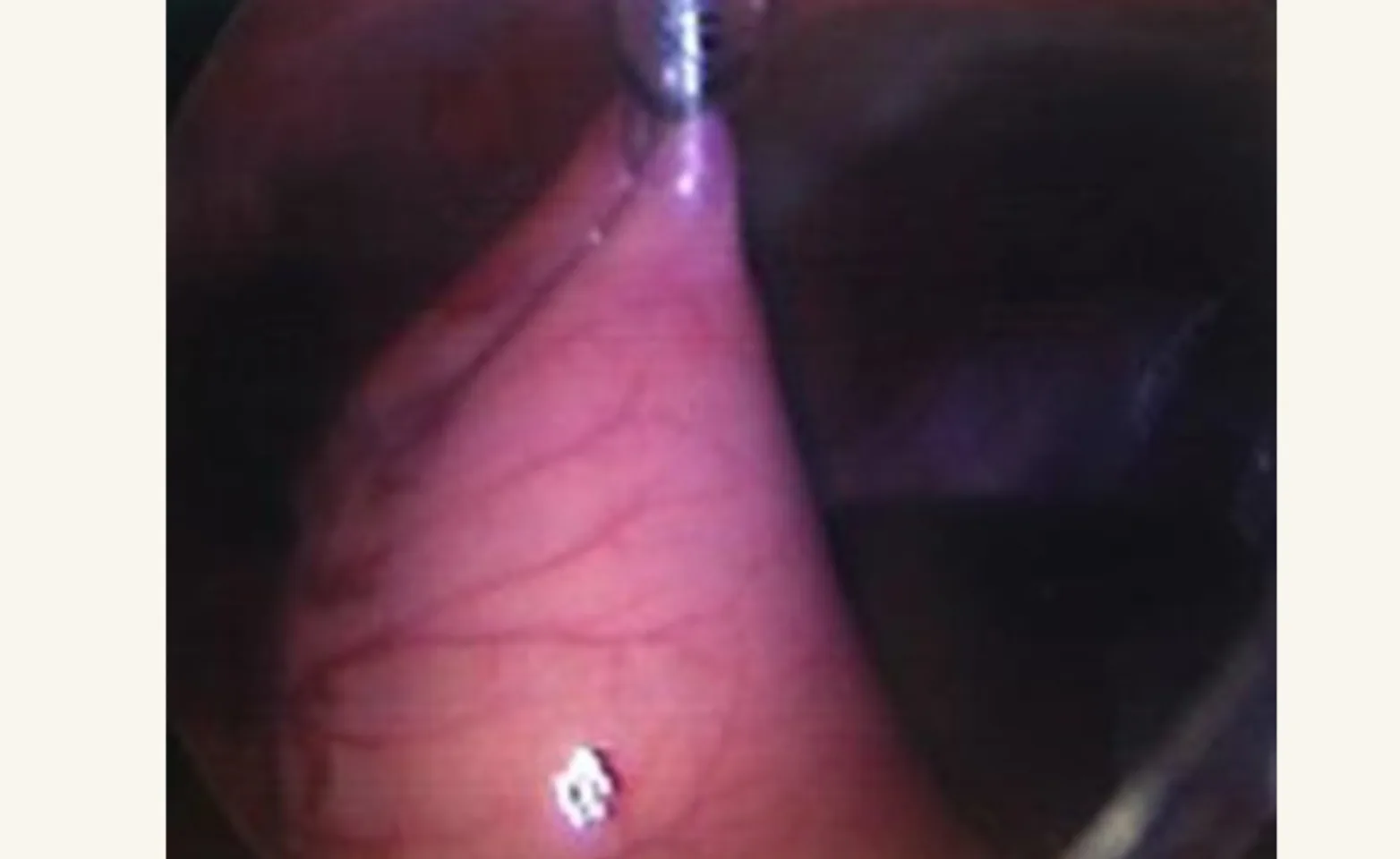 laparoscope inside the abdomen laparoscope inside the abdomen