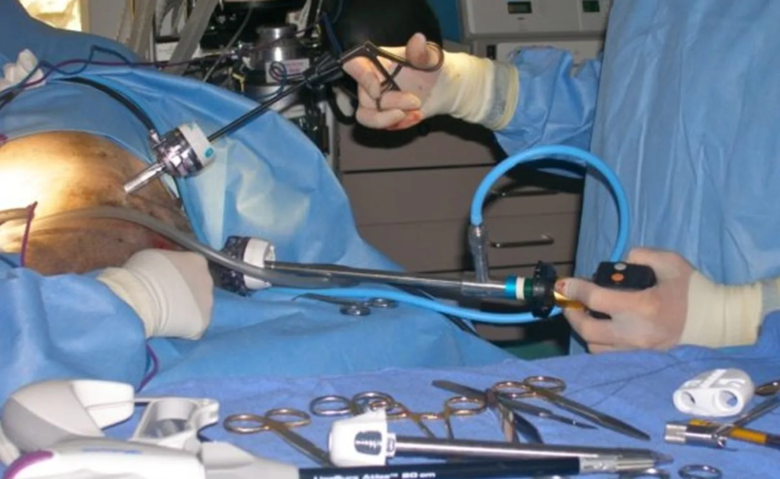 laparoscope connected to a video monitor laparoscope connected to a video monitor