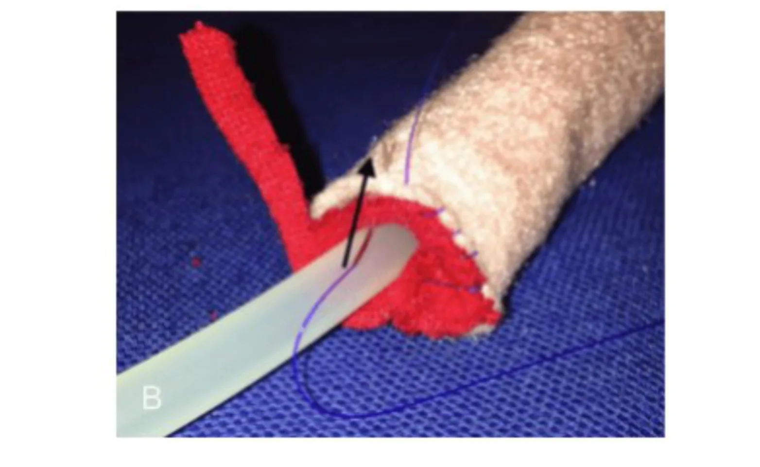 Surgical model demonstrating suturing the mucosa to the penis. Surgical model demonstrating suturing the mucosa to the penis.
