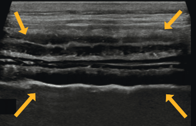 Ultrasonographic image showing severe thickening of the small intestinal submucosa with numerous submucosal and adjacent mucosal punctate hyperechoic foci (arrows).