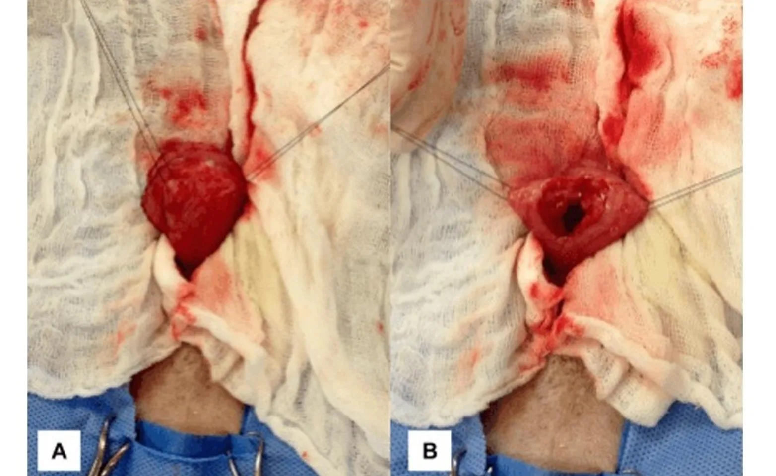 Bladder surgery Bladder surgery