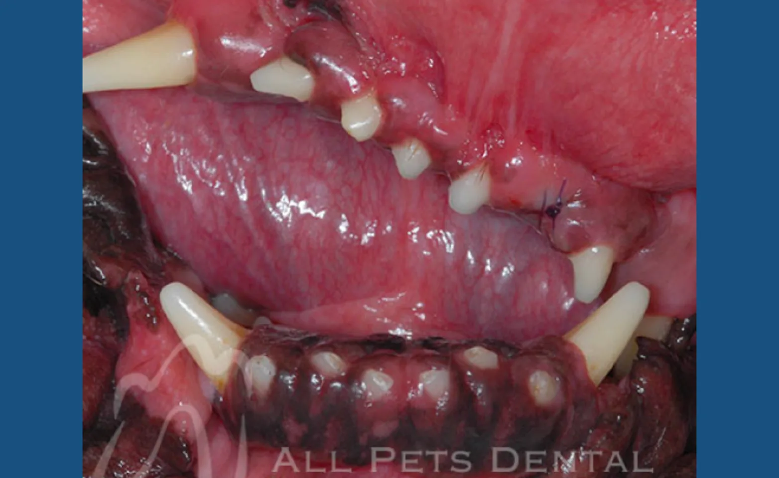 Maxillary Mandibular Assymetry Maxillary Mandibular Assymetry
