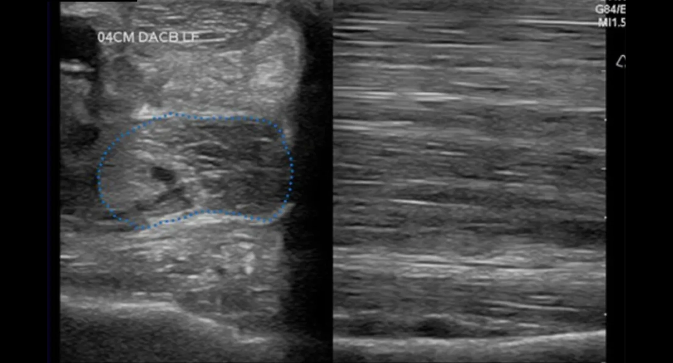 Ultrasound of a Horse with Ligament Injury Ultrasound of a Horse with Ligament Injury