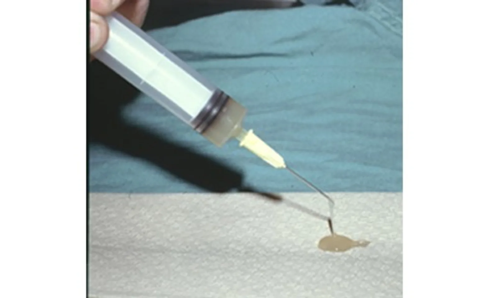 Aspiration of a sialocele Aspiration of a sialocele