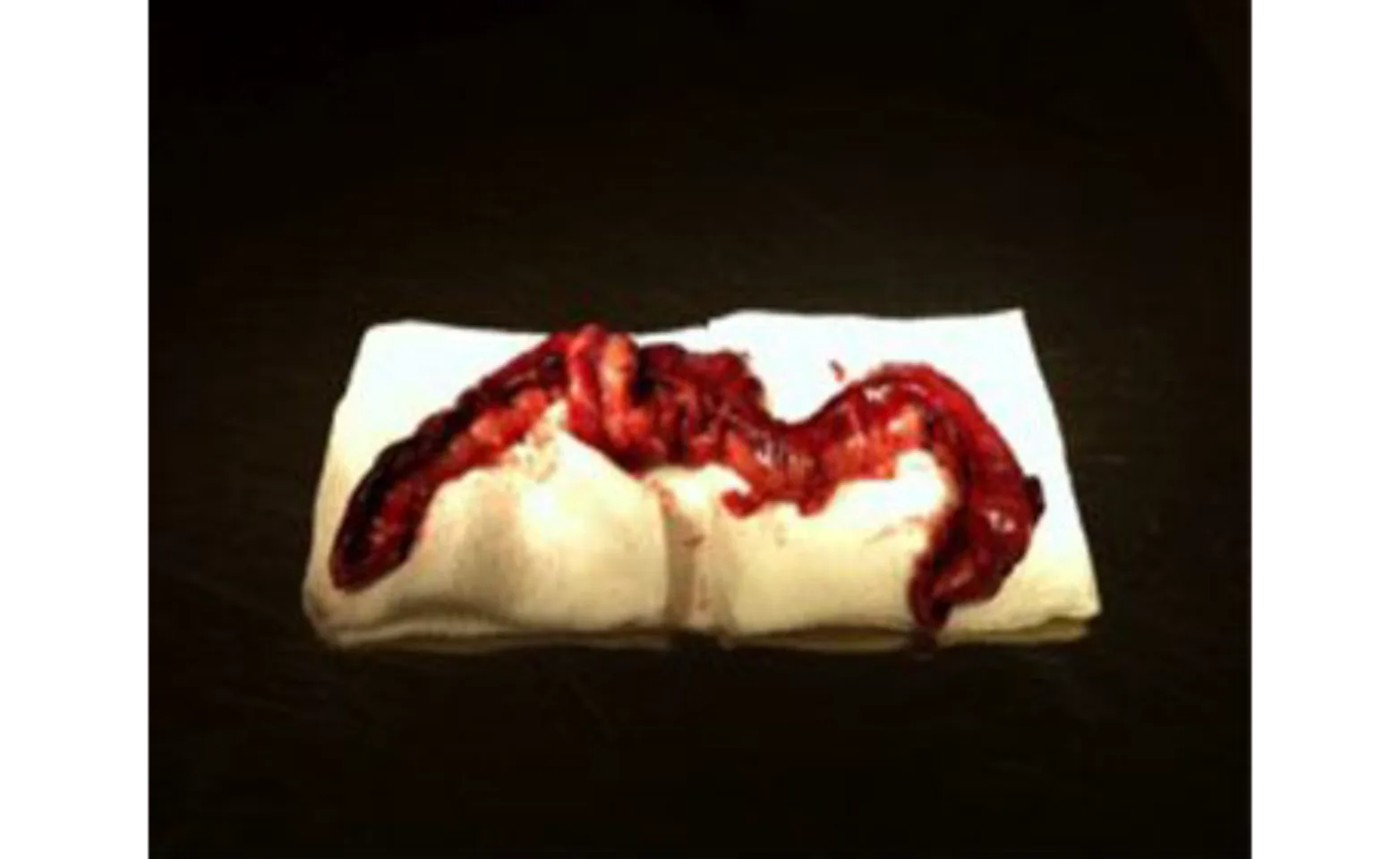 Bowel removal Bowel removal