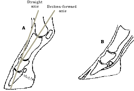 Clubbed foot illustration