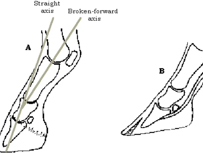 Clubbed foot illustration Clubbed foot illustration