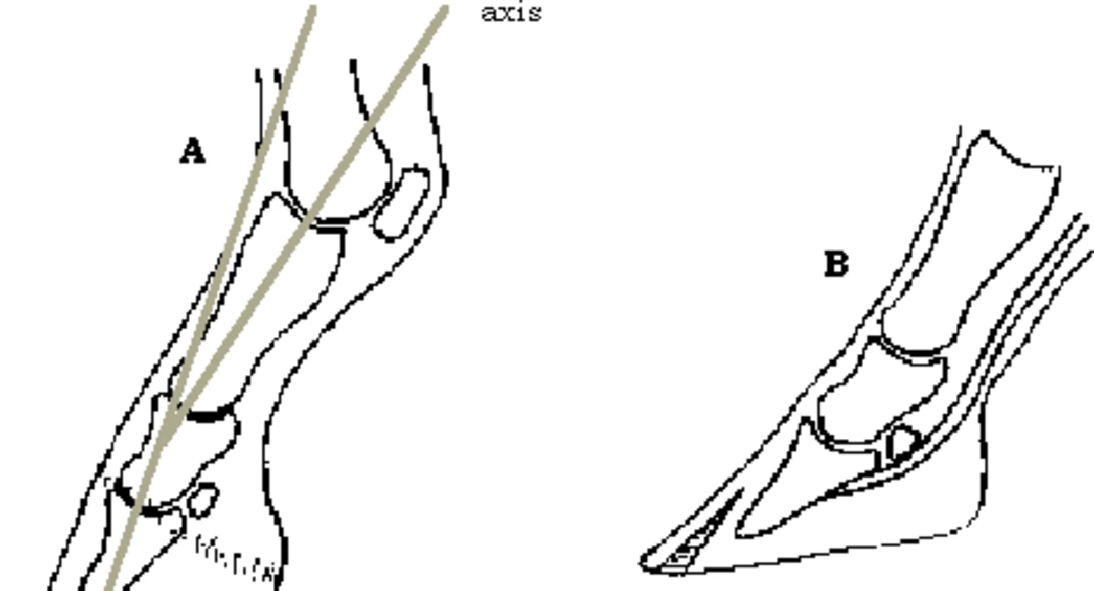 Clubbed foot illustration Clubbed foot illustration