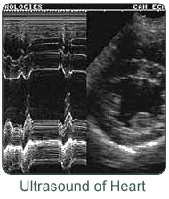Ultrasound of Heart