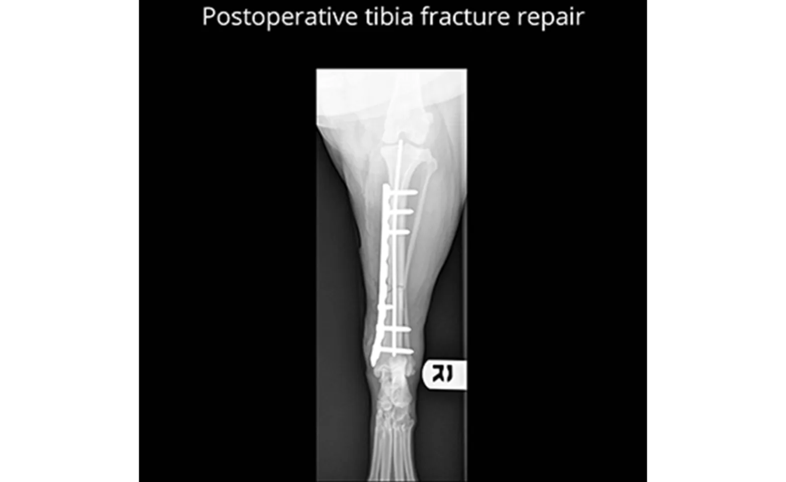 Postoperative Tibia Fracture Repair X-Ray Postoperative Tibia Fracture Repair X-Ray