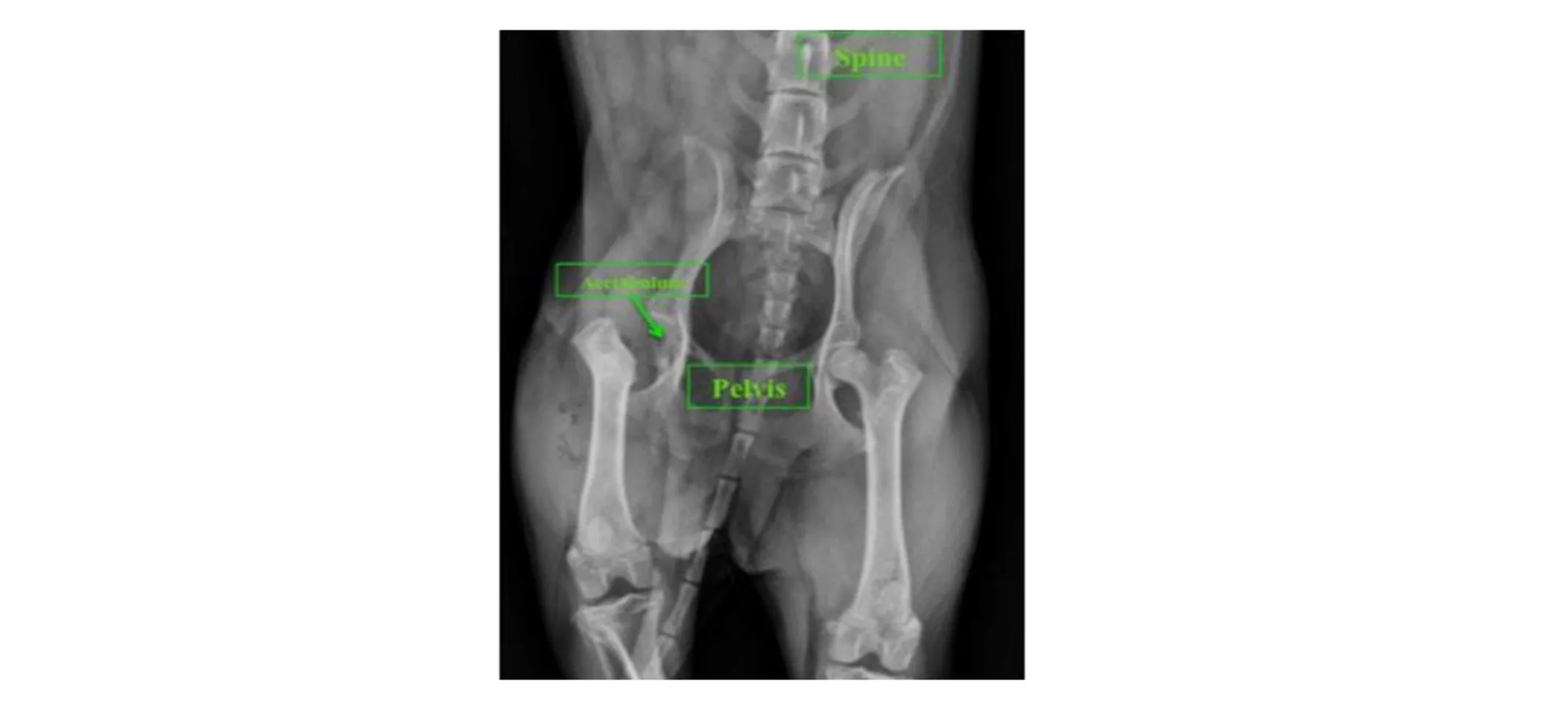 X-ray of a patient experiencing aseptic necrosis of the femoral head X-ray of a patient experiencing aseptic necrosis of the femoral head
