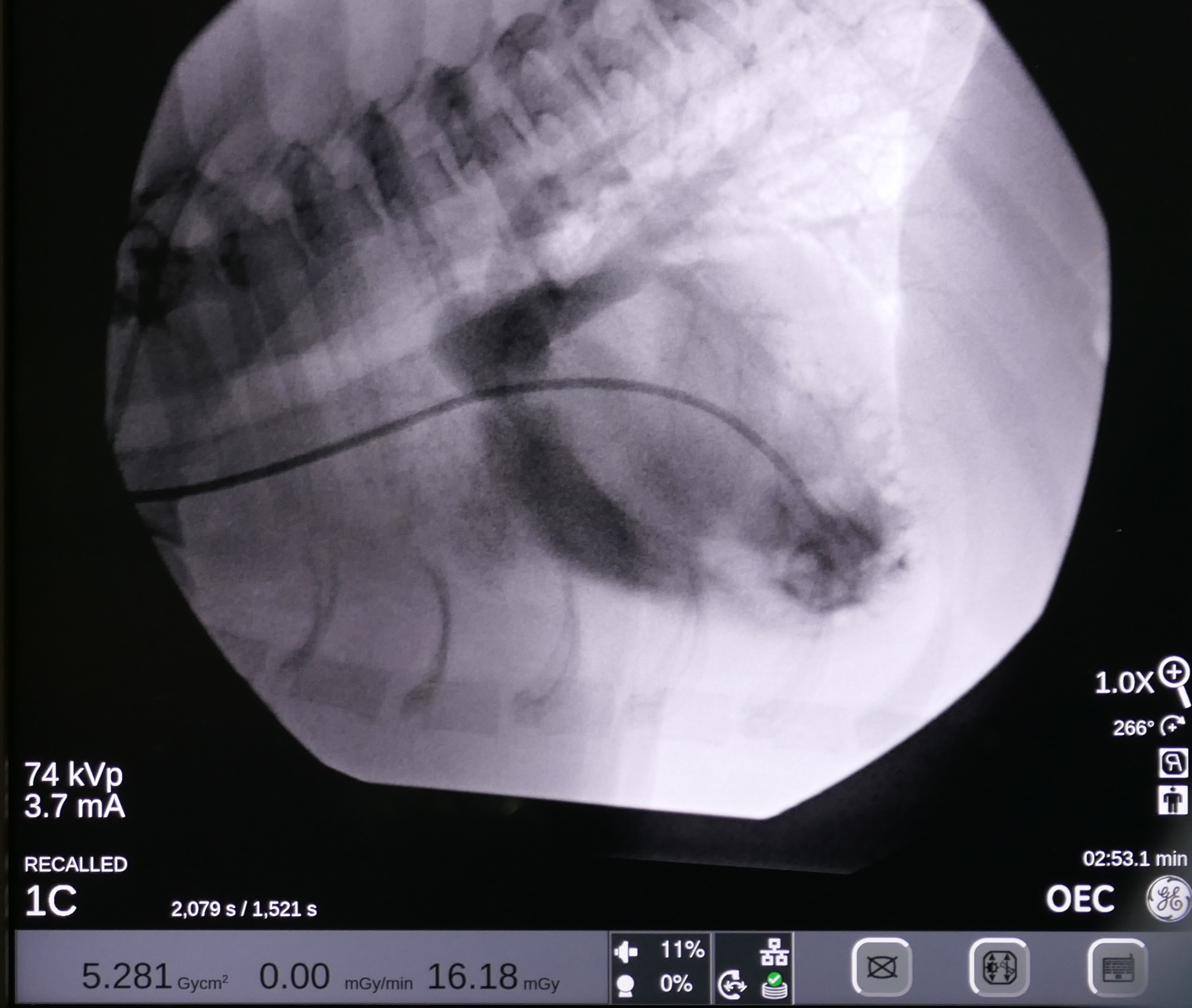 Balloon Valvuloplasty X-rays. 