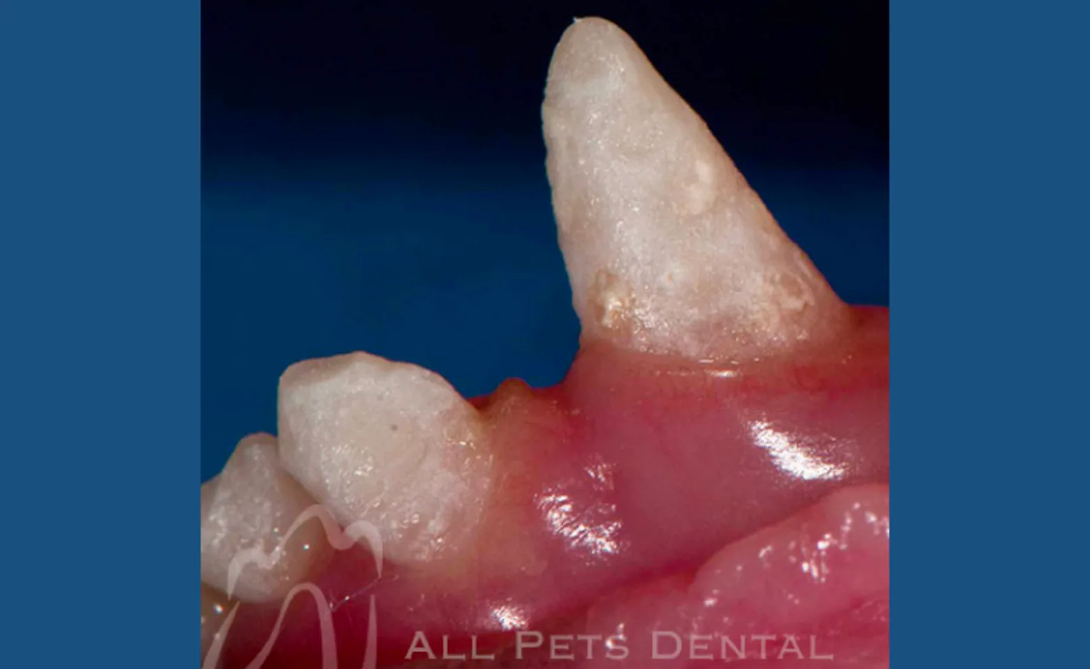 Enamel Hypomineralization Enamel Hypomineralization