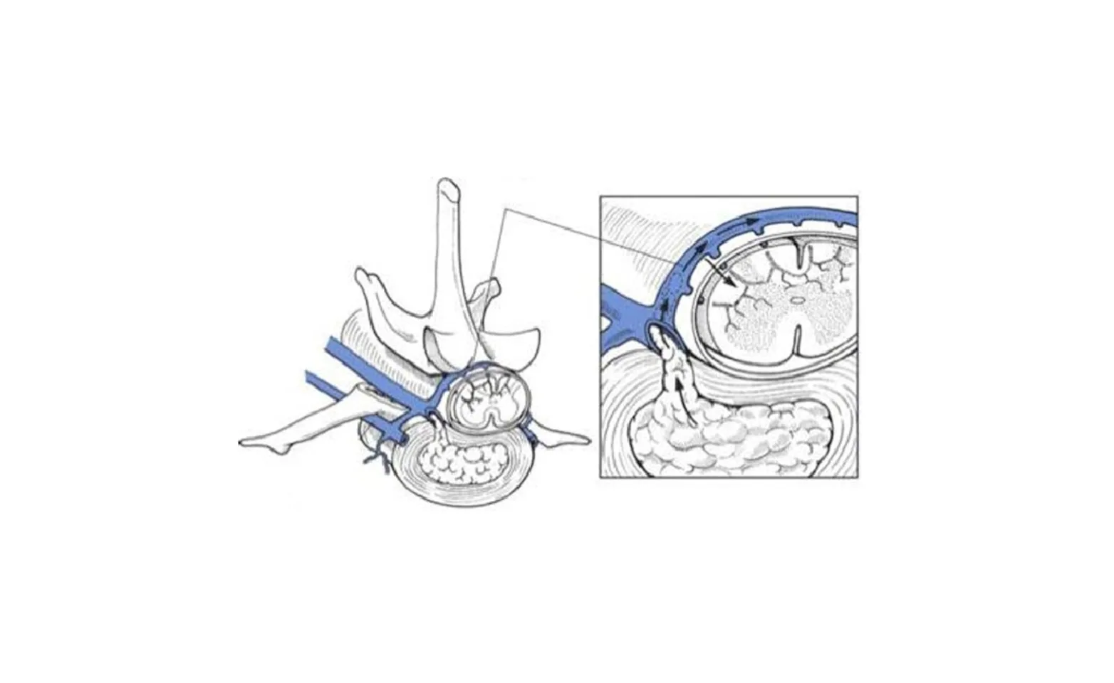 Diagram of Fibrocartilaginous embolism Diagram of Fibrocartilaginous embolism