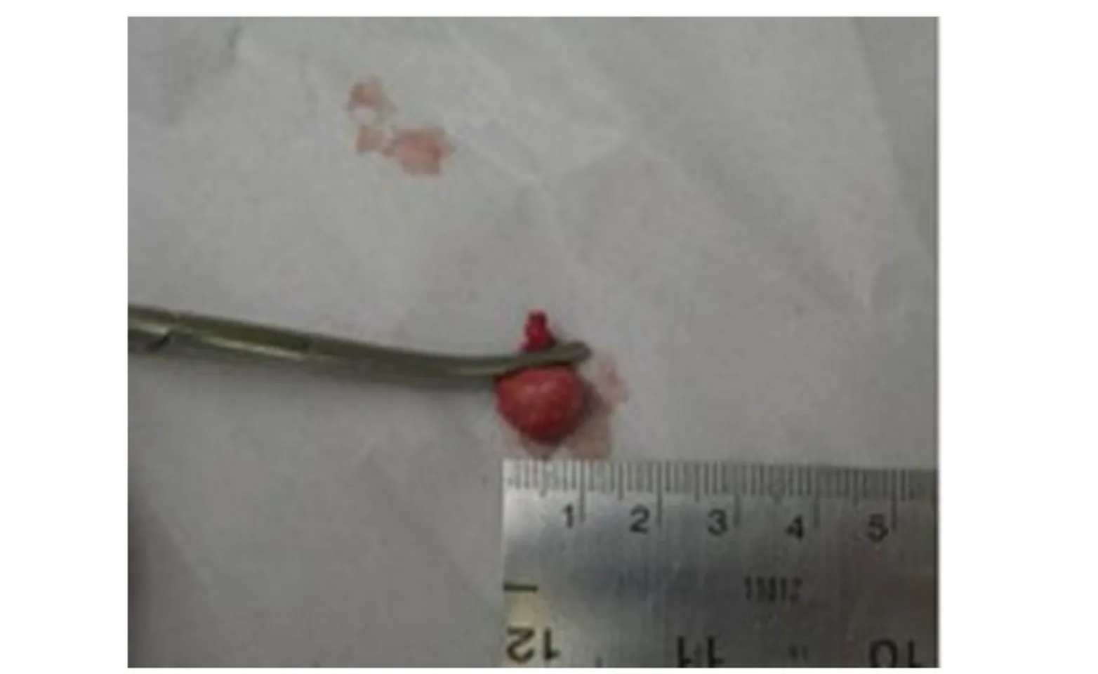 Photograph of an anal sac after removal. Photograph of an anal sac after removal.