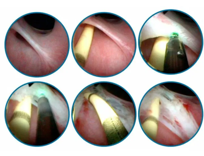 Series of surgical Images of Correcting Congenital Ectopic Ureters Series of surgical Images of Correcting Congenital Ectopic Ureters