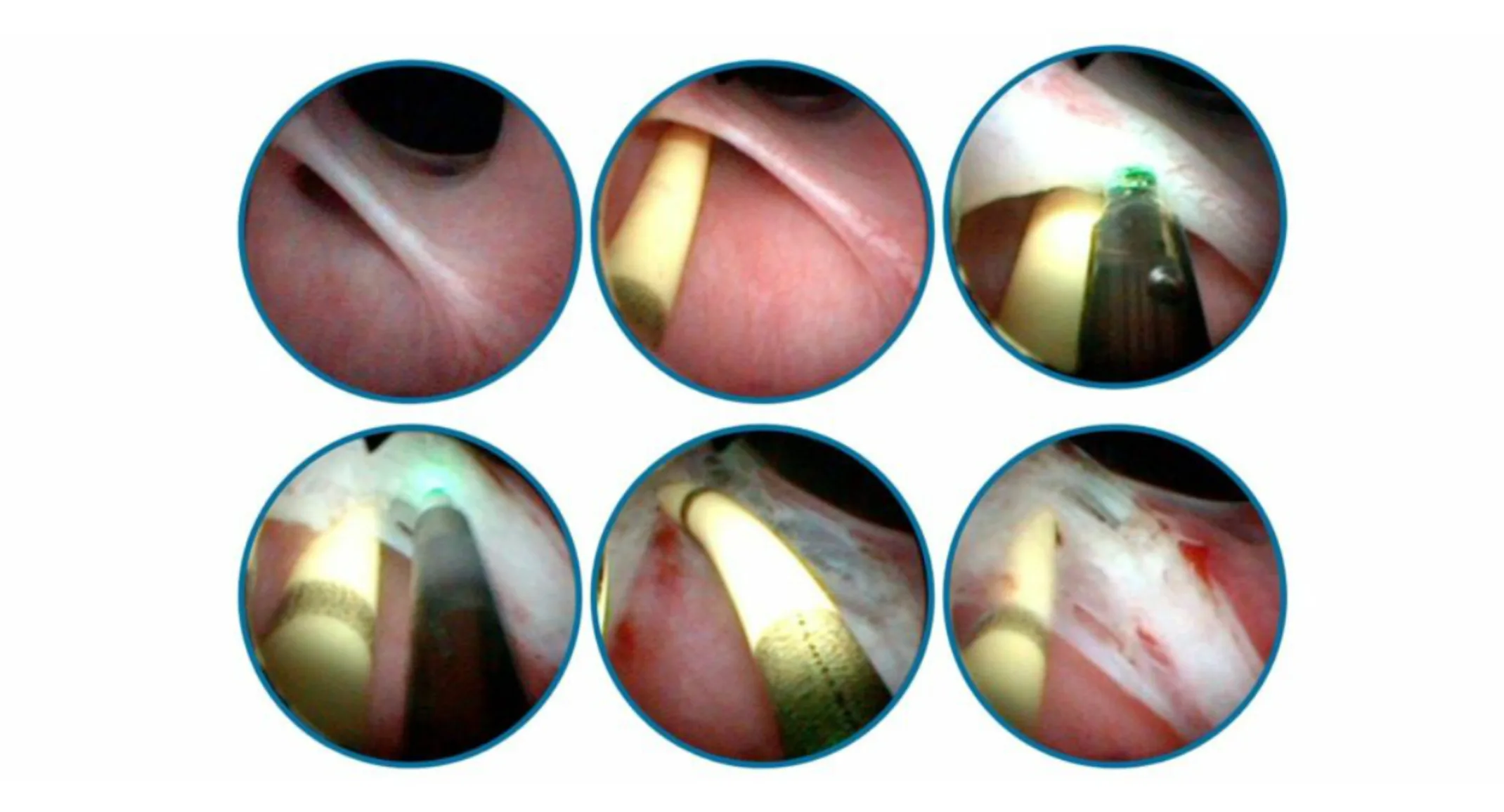 Series of surgical Images of Correcting Congenital Ectopic Ureters Series of surgical Images of Correcting Congenital Ectopic Ureters