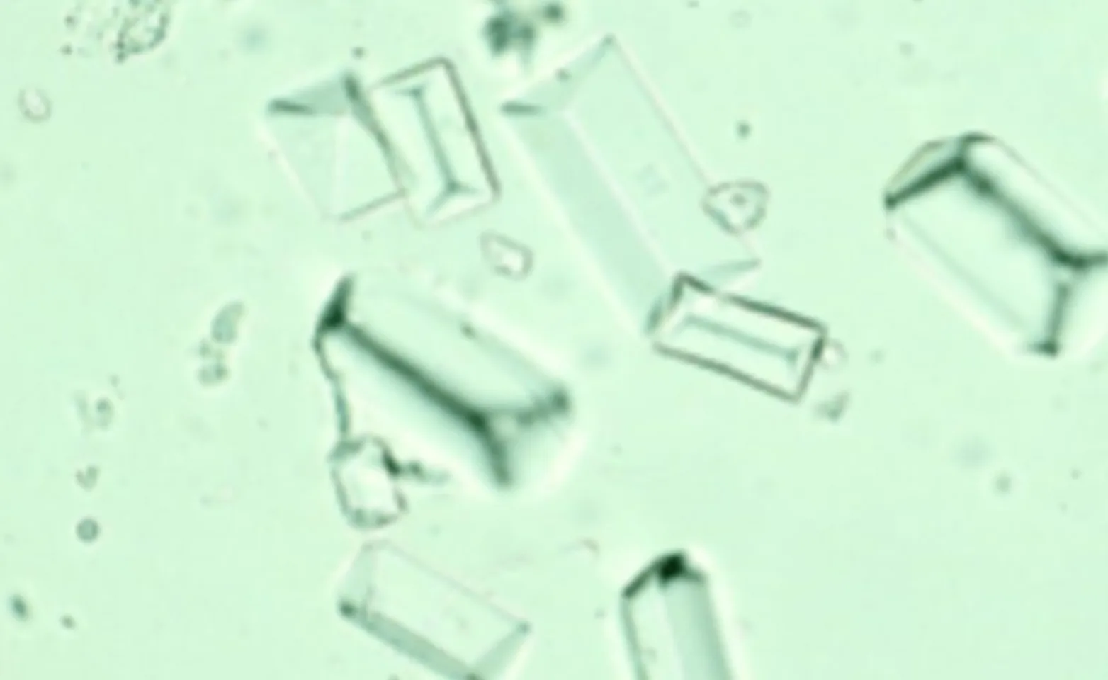 Struvite crystals in urine sediment Struvite crystals in urine sediment