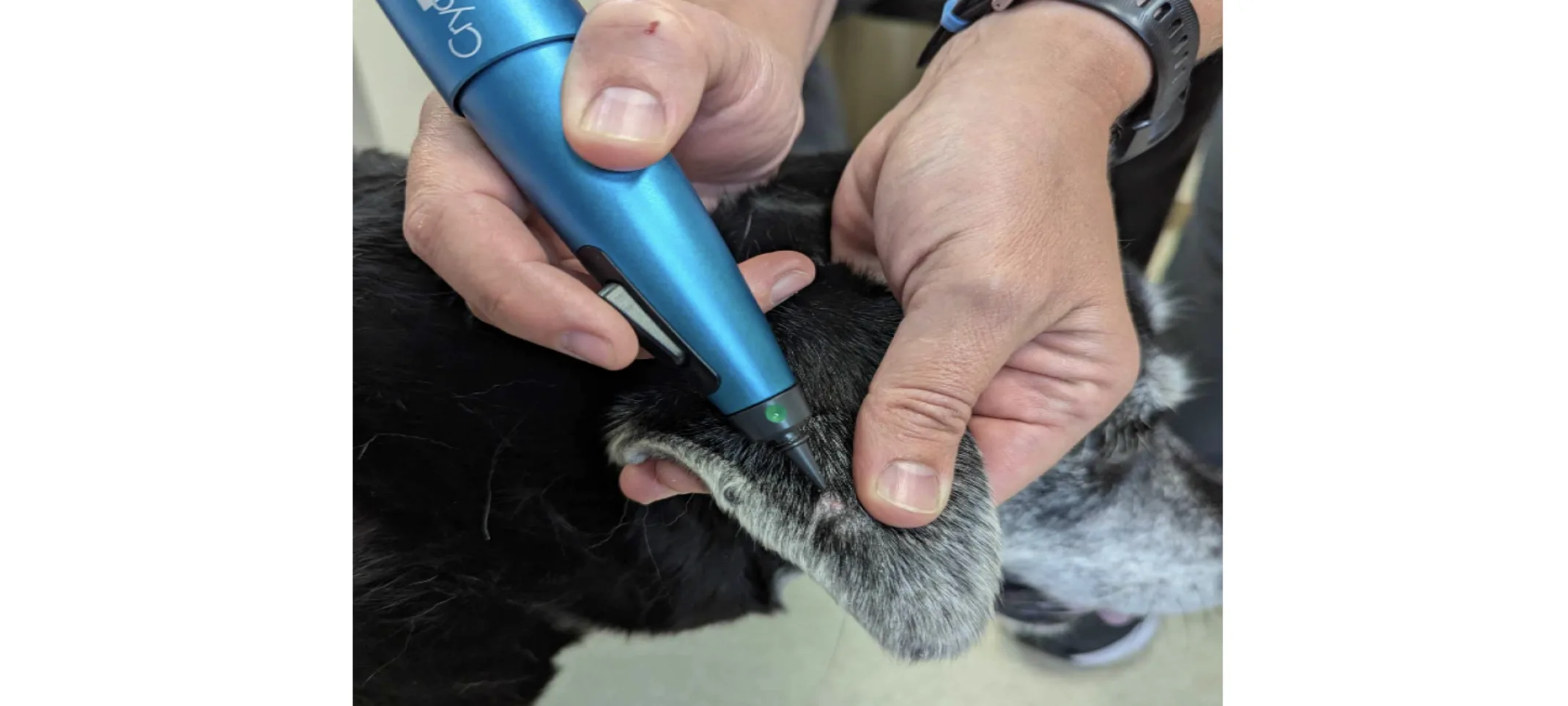 Cryotherapy pen being used on patient Cryotherapy pen being used on patient