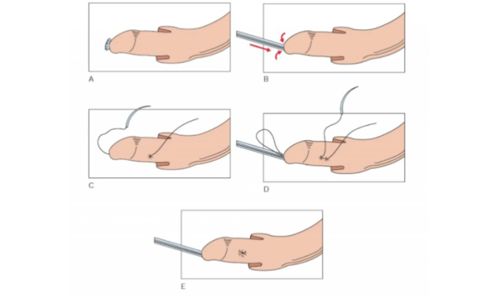 Figure 4. Urethropexy procedure. Figure 4. Urethropexy procedure.