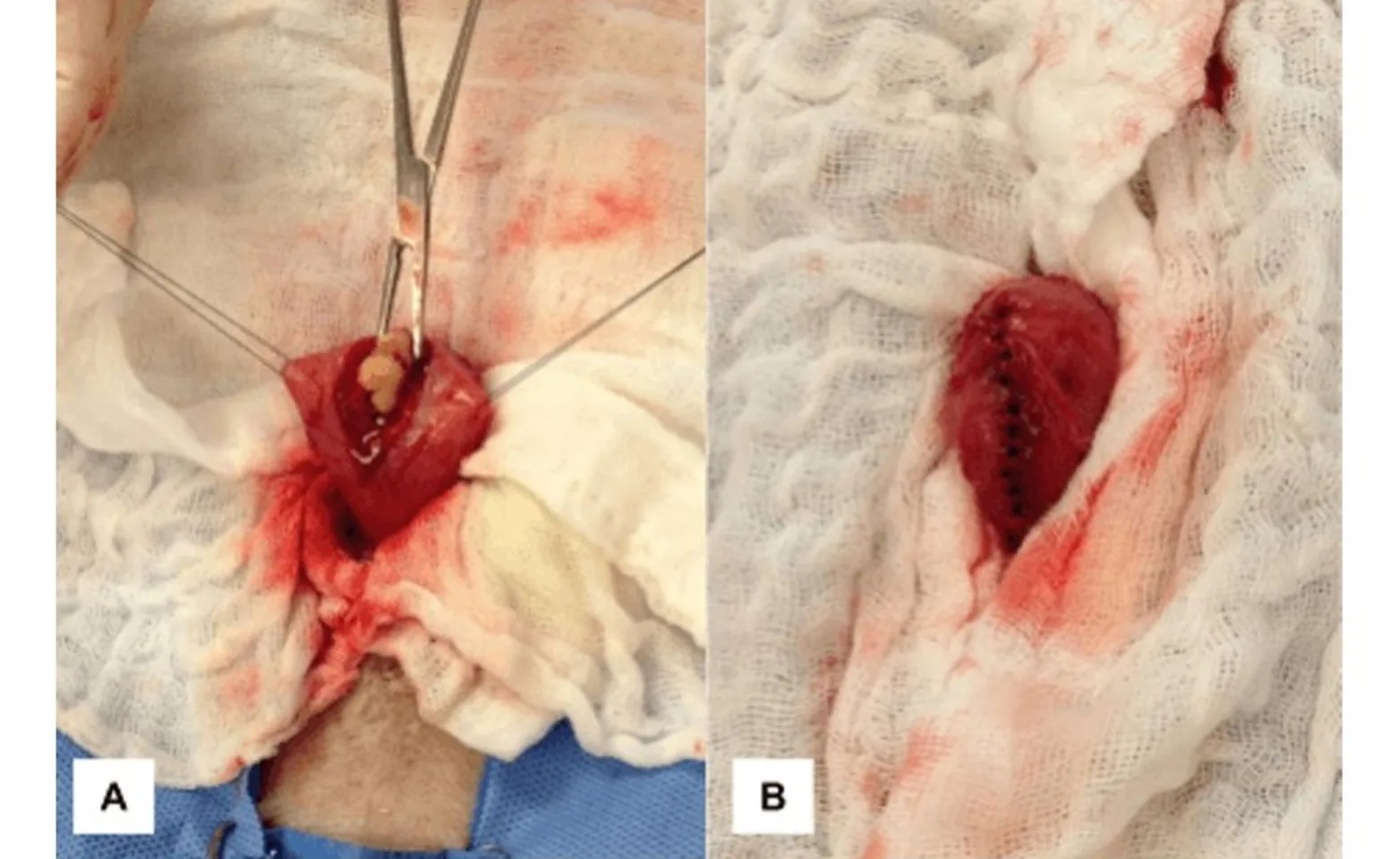 Bladder stone removal Bladder stone removal