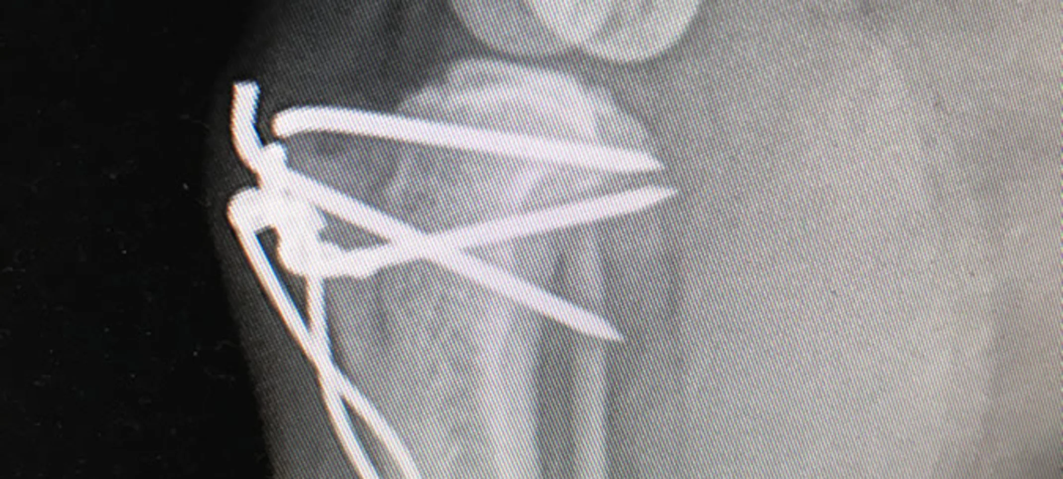 X-Ray of patellar luxation procedure X-Ray of patellar luxation procedure