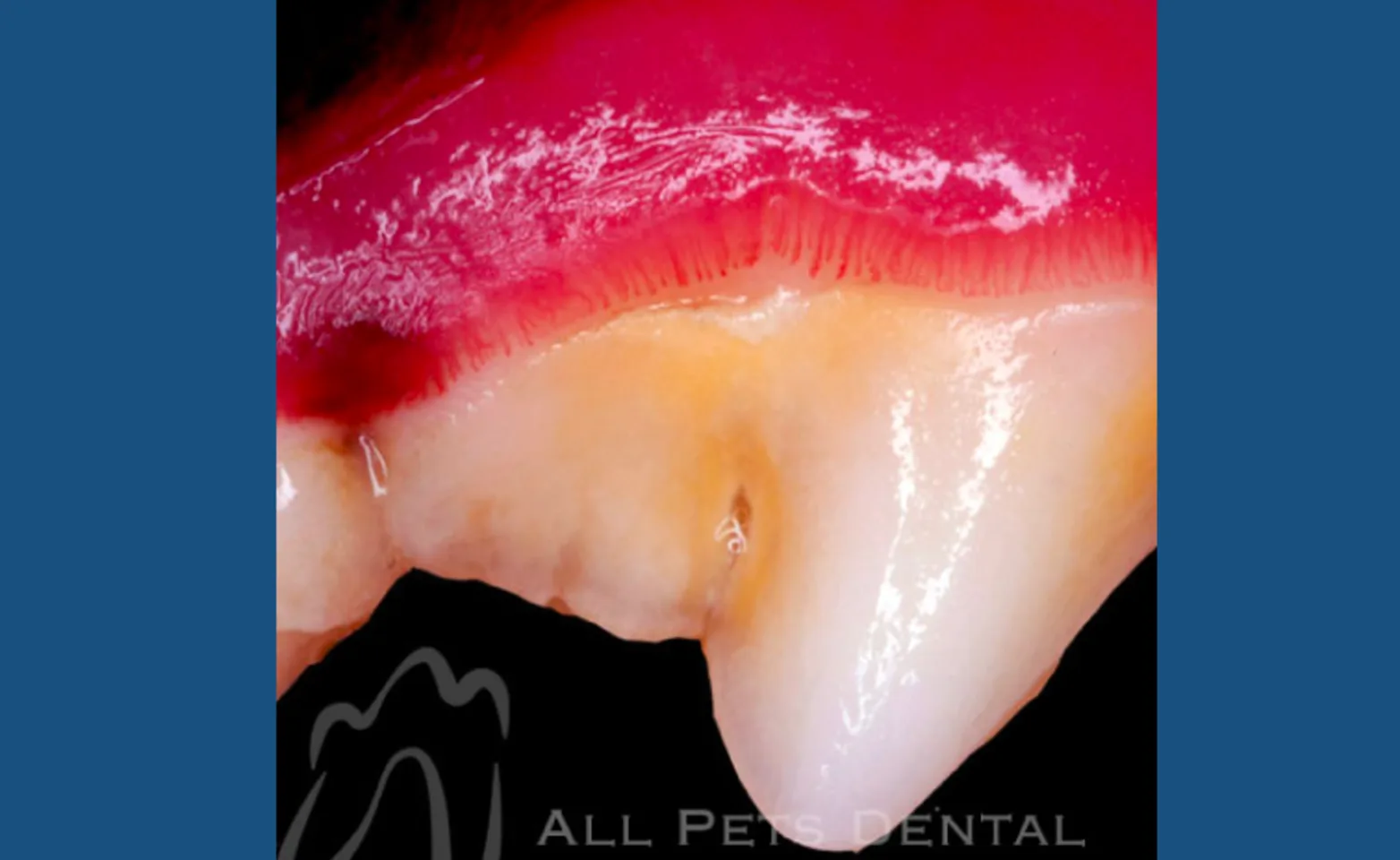 Stage 1 of Periodontal Disease Stage 1 of Periodontal Disease