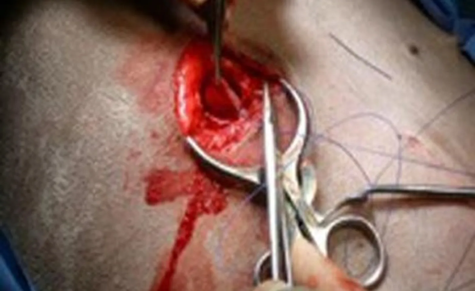 small incision made on the right body wall small incision made on the right body wall